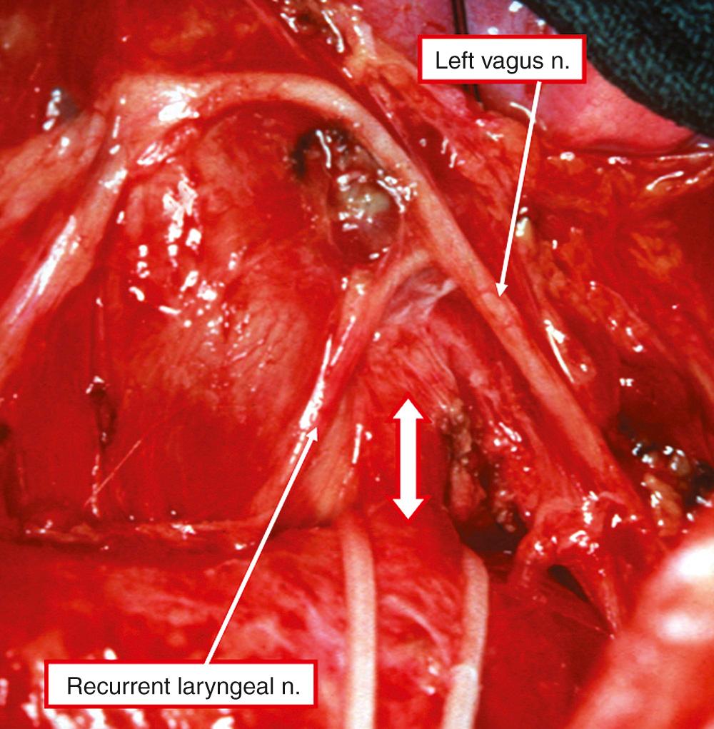 Fig. 41.4, View through a left thoracotomy shows the relationship of the left recurrent laryngeal nerve to the persistently patent arterial duct (double-headed arrow).