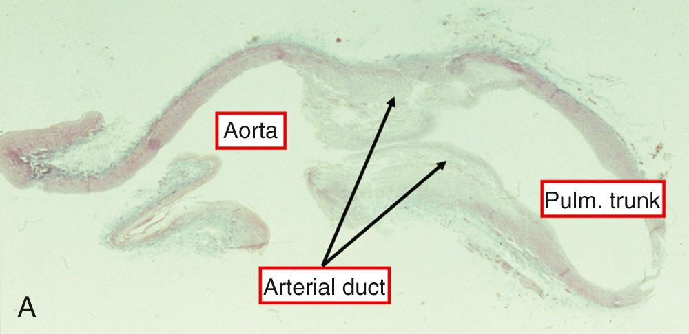 Fig. 41.5, (A) Microscopic trichrome-stained section showing the markedly different aspect of the muscular walls of the arterial duct compared with the fibroelastic walls of the aorta and pulmonary trunk. (B) Note the intimal mounds within the ductal lumen (left) , which can be appreciated in the opened closing duct (right).