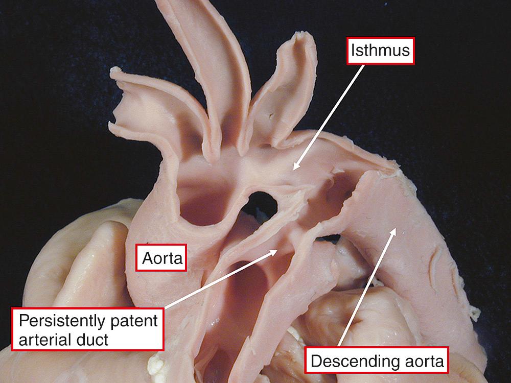 Fig. 41.7, Dissection showing the course of a persistently patent arterial duct. As expected, it follows the course of the channel seen at birth (see Fig. 41.3 ).
