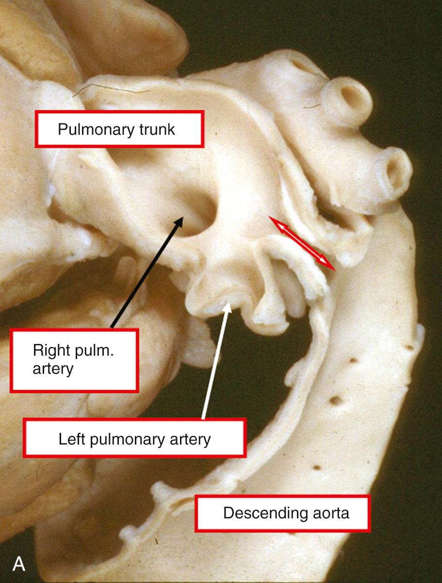 Fig. 41.8, Variation in size of the persistently patent arterial duct (double-headed arrows). (A) Relatively narrow lumen of the channel. (B) Wide lumen of the channel .