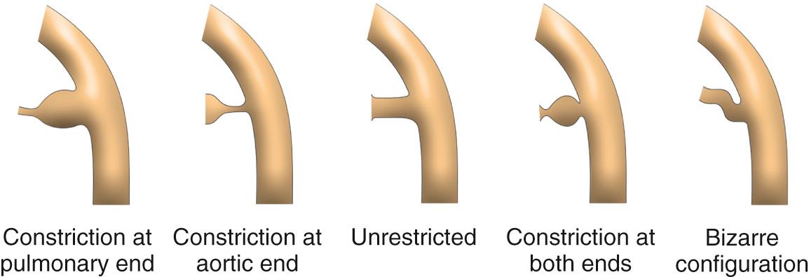 Fig. 41.9, Variation in morphology of the arterial duct noted from angiograms taken prior to interventional closure.