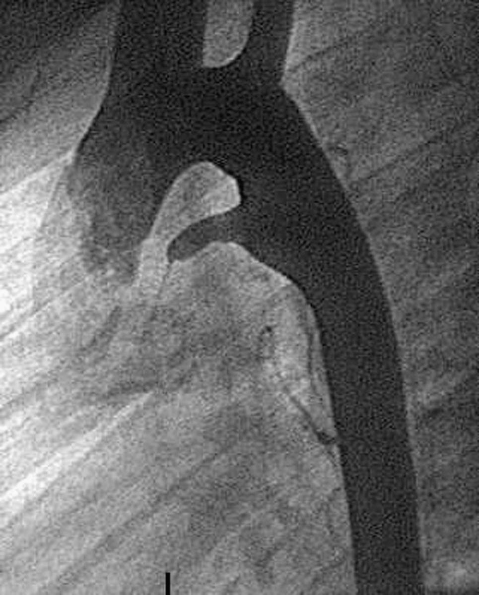 Fig. 41.10, Lateral angiogram of a child with an elongated duct taken before transcatheter occlusion.