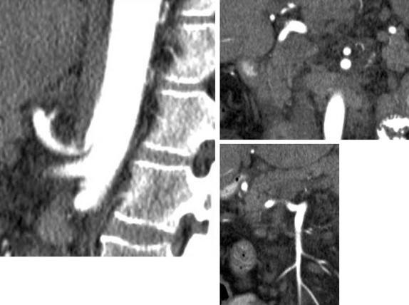 FIGURE 61-5, Sagittal slice on computed tomography angiogram shows median arcuate ligament syndrome with severe soft tissue compression of the celiac axis as it arises from the anterior aorta. This patient had a large collateral connecting the superior mesenteric and celiac circulations, thus providing arterial flow around the compressed celiac ostium. The patient underwent successful liver transplantation with the arterial anastomosis positioned distal to the confluence of the large collateral with the common hepatic artery. This reconstruction obviated the need for lysis of the median arcuate ligament or aortohepatic grafting.