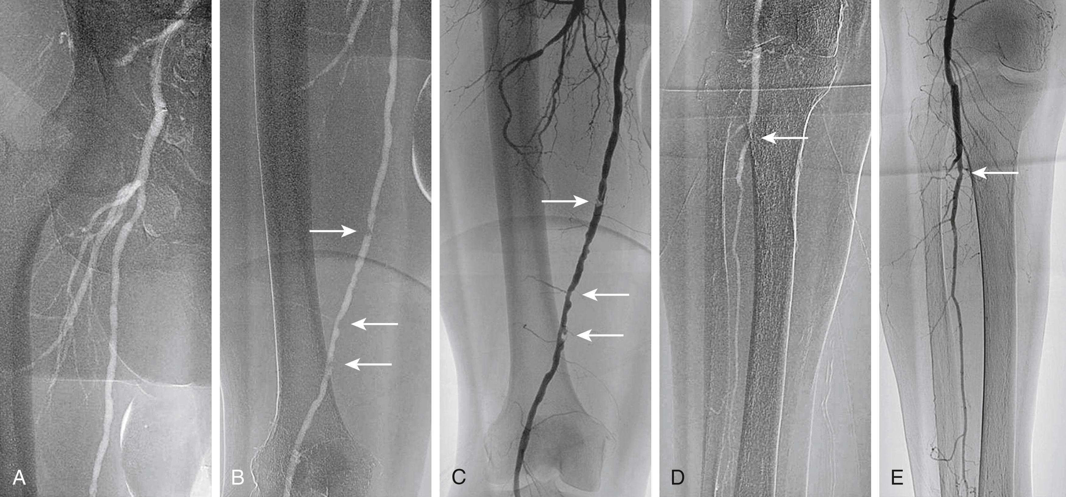 Figure 27.4, ( A ) Angiogram of the femoral bifurcation visualized with CO 2 contrast and selective placement of the catheter in the common femoral artery. ( B ) Opacification of the superficial femoral artery reveals multiple stenoses (arrows) . ( C ) Comparison of the same vessel opacified with iodinated contrast material shows much better characterization of each stenosis (arrows) . ( D ) Distal views show relatively well-visualized popliteal and single-vessel peroneal runoff with CO 2 ; significant disease is evident at the proximal peroneal artery (arrow) . ( E ) Again, better characterization with iodinated contrast material reveals only a mild stenosis at the proximal peroneal artery (arrow) .