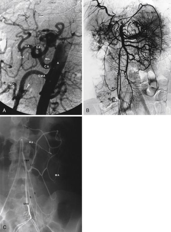 FIGURE 1, Normal vascular anatomy. A, Normal lateral abdominal aortogram (digital subtraction technique). The celiac artery ( CA ; 8 mm in diameter) arises from the ventral surface of the aorta (A) and courses anteroinferiorly for 1 cm before curving anterosuperiorly. After giving rise to the left gastric artery (arrow) , the CA divides into the splenic (SA) and hepatic (HA) arteries. The common hepatic artery becomes the proper hepatic after the origin of the gastroduodenal artery (GDA). The superior mesenteric artery ( SMA; 7 mm in diameter) originates from the ventral surface of the aorta 1.2 cm inferior to the lower margin of the CA. It courses ventrally for 3 cm before curving inferiorly. The inferior pancreaticoduodenal artery (arrowhead) arises from the SMA before the middle colic (MC) artery. B, Normal superior mesenteric arteriogram (digital subtraction technique). Right hepatic (RH) artery originates from the SMA. Right colic (RC) artery arises from the ileocolic (IC) artery. The middle colic artery participates in the marginal artery (MA) from which the left colic (LC) branch filled faintly. C, Normal inferior mesenteric arteriogram (cut-film technique). The inferior mesenteric artery (IMA) gives off the left colic (LC) , sigmoidal (S) , and superior hemorrhoidal (SHA) arteries. The branches of the left colic and sigmoidal arteries participate in the marginal artery (MA) of Drummond. The middle colic (MC) artery is filled from the marginal artery.
