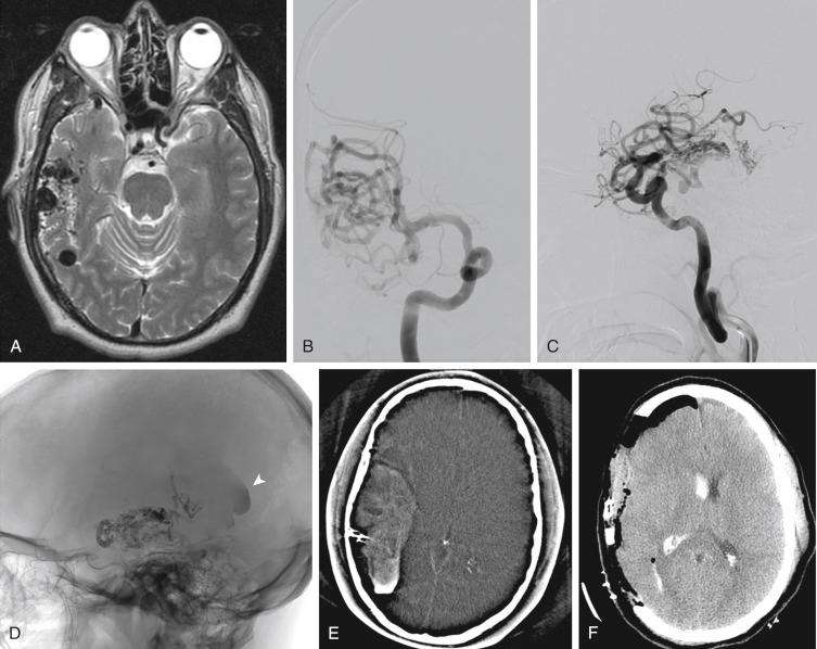 Fig. 37.1, Hemorrhage after AVM embolization.