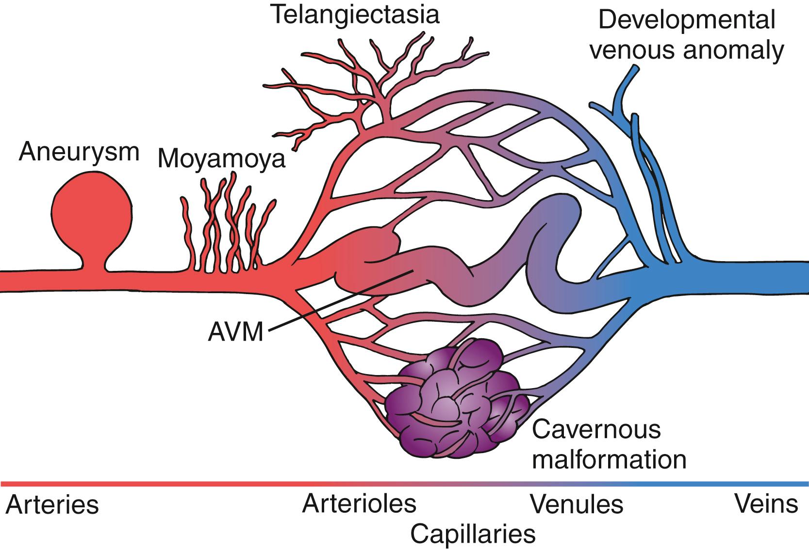 Fig. 30.1, Synopsis of intracerebral vascular anomalies. Only arteriovenous malformations (AVMs) , cavernous malformations, and capillary telangiectasias are considered true malformations.