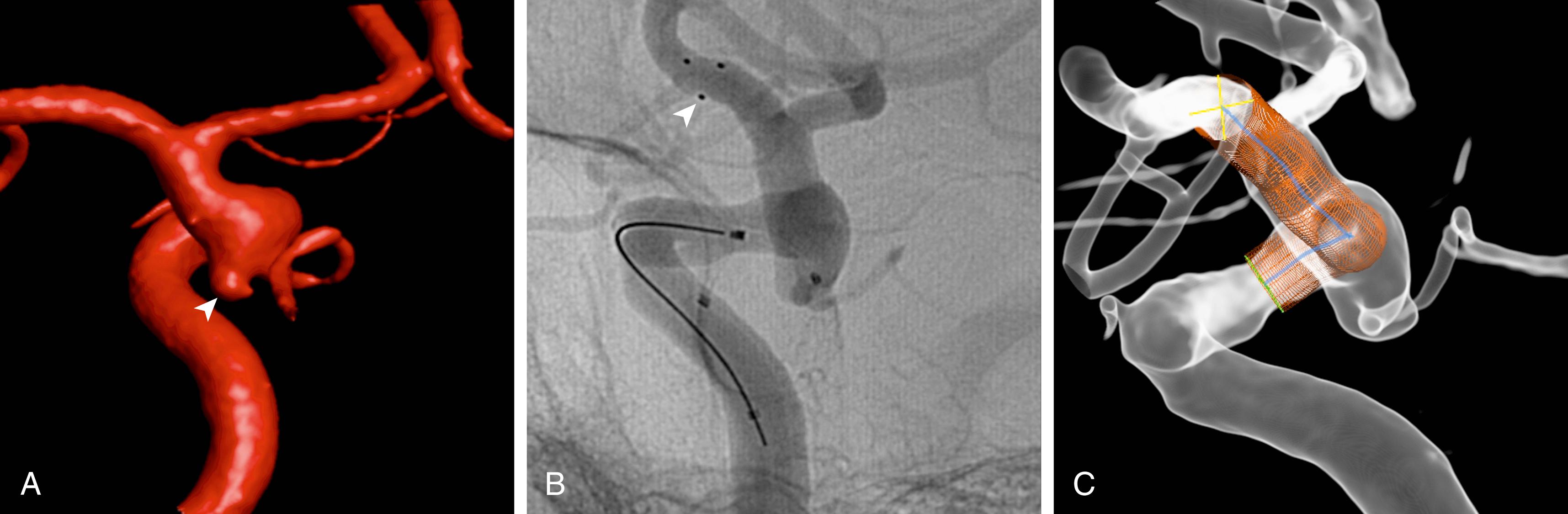 Fig. 30.2, Three-dimensional (3D) rotational angiogram reconstruction showing a ruptured posterior communicating artery aneurysm (A, arrowhead ) and a dysplastic carotid artery. A stent was deployed in the parent artery to protect the neck of the aneurysm (B, unsubstrated angiogram, arrowhead pointing to the distal stent struts; and (C) virtual 3D reconstruction simulating the stent deployed across the aneurysm and the dysplastic internal carotid artery).