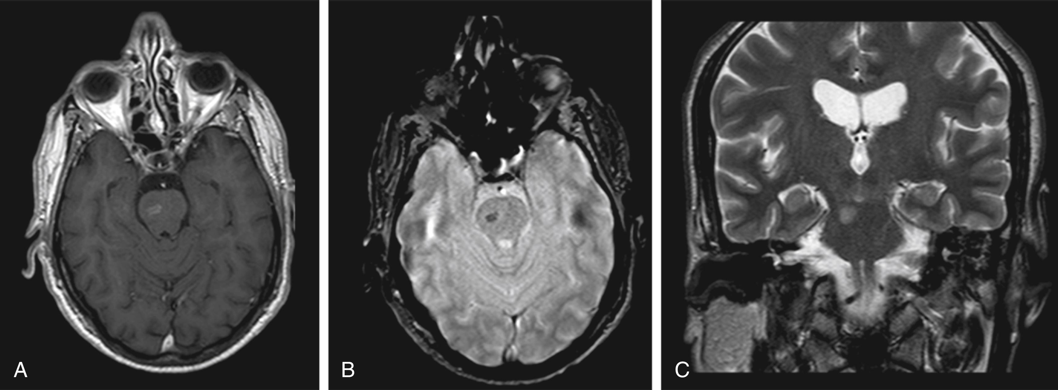 Fig. 30.3, Asymptomatic pontine telangiectasia with hyperintense signal on T1-weighted images after contrast injection (A), hemosiderin staining on gradient echo (B), and a spontaneously hyperintense signal on standard T2 imaging (C).