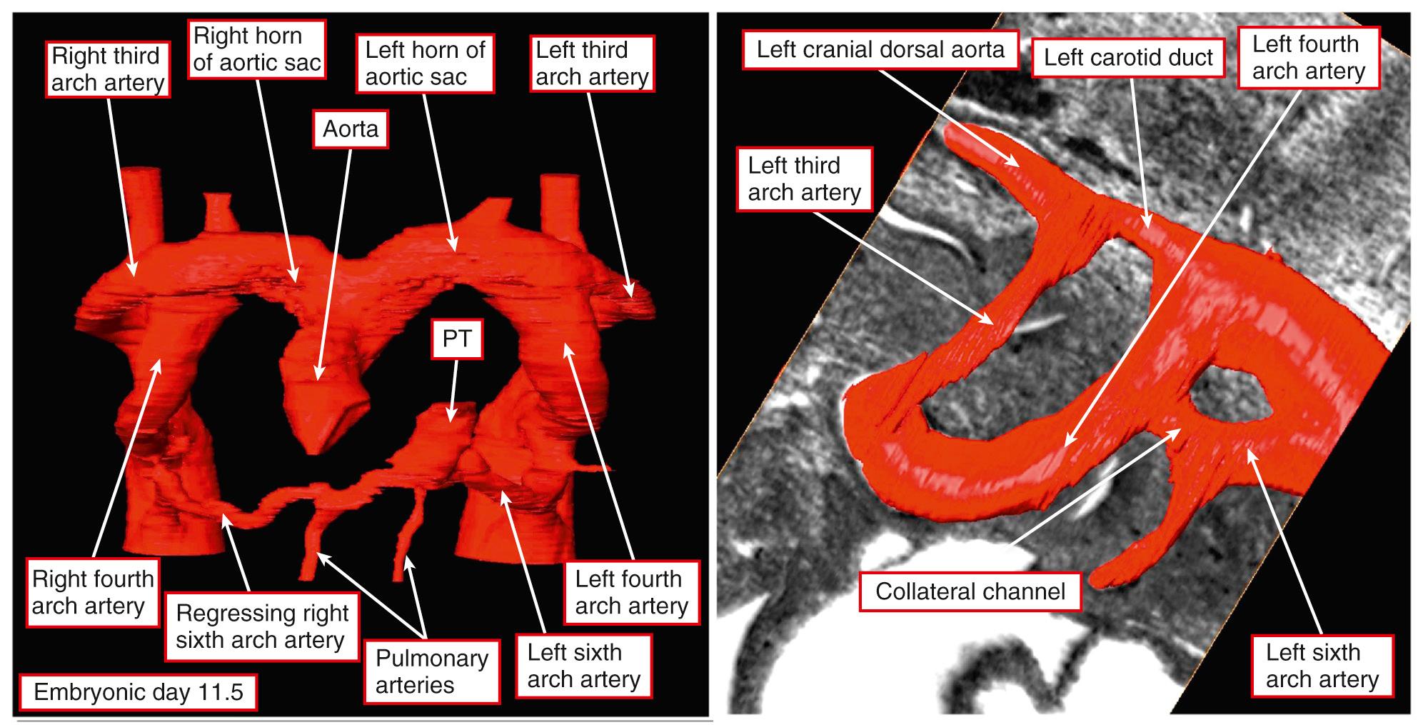 Fig. 48.4, Reconstructions of the arch arteries from an episcopic dataset from a developing mouse sacrificed during embryonic day 11.5. The left panel shows a frontal view of the reconstruction. By now the intrapericardial outflow tract has separated into the aorta and the pulmonary trunk (PT) . The right panel shows a view of the left-sided channels. Note the collateral channel formed between the connections of the fourth and sixth arch arteries with the dorsal aorta. Such collateral channels are found in up to half of all normal mouse embryos. Note also the regressing right sixth arch artery.