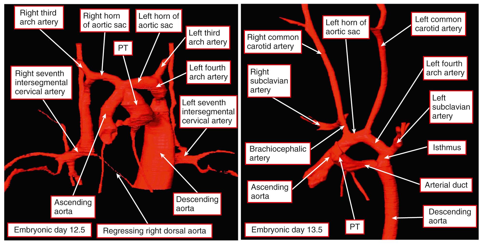 Fig. 48.5, Reconstructions from episcopic datasets derived from developing mice showing the major remodeling that transforms the aortic sac and its right and left horns into the aortic arch and the brachiocephalic arteries. This involves marked migration of the seventh cervical intersegmental artery, which becomes the subclavian artery on both sides. Although it seems that the seventh segmental artery migrates cranially, this structure is fixed. It is more likely, therefore, that the pharyngeal mesenchyme moves caudally. On the left side, the relative movements take the segmental artery across the junction of the sixth arch artery, which becomes the arterial duct and the dorsal aorta. In its eventual position, it divides the fourth arch artery into the transverse aortic arch and the aortic isthmus. Comparable movements take place on the right side. The left panel, shown in frontal projection, is from an embryo sacrificed at embryonic day 12.5, whereas the right panel, viewed obliquely from the left side, is from an embryo sacrificed at embryonic day 13.5. PT , Pulmonary trunk.