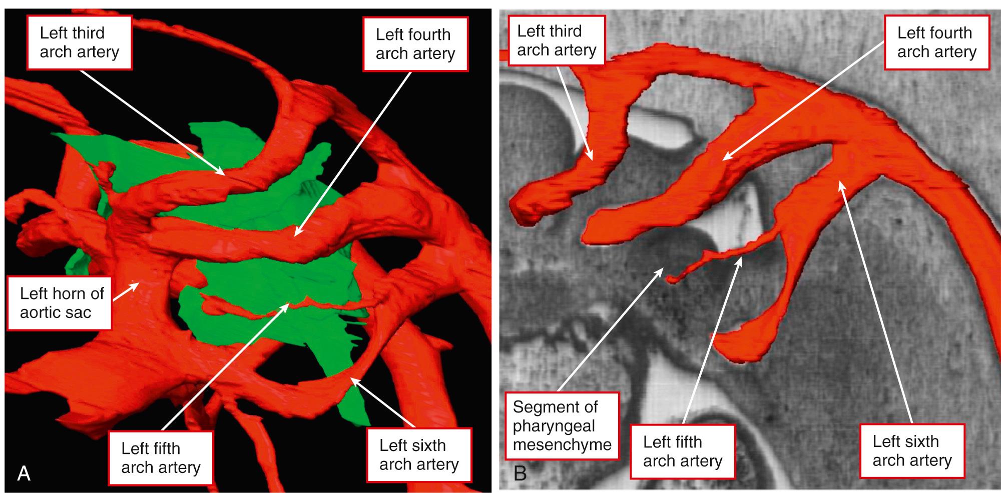 Fig. 48.6, Images showing the course of the vessel found in a solitary human embryo, at Carnegie stage 14, equivalent to embryonic day 10.5 in the mouse, in which there is evidence of an artery of the fifth pharyngeal arch. (A) Oblique view of the channel from the left side, with the pharyngeal endoderm reconstructed in green. (B) Left lateral view showing how the vessel is contained within a discrete segment of pharyngeal mesenchyme. It joins the sixth arch artery to gain its attachment to the dorsal aorta.