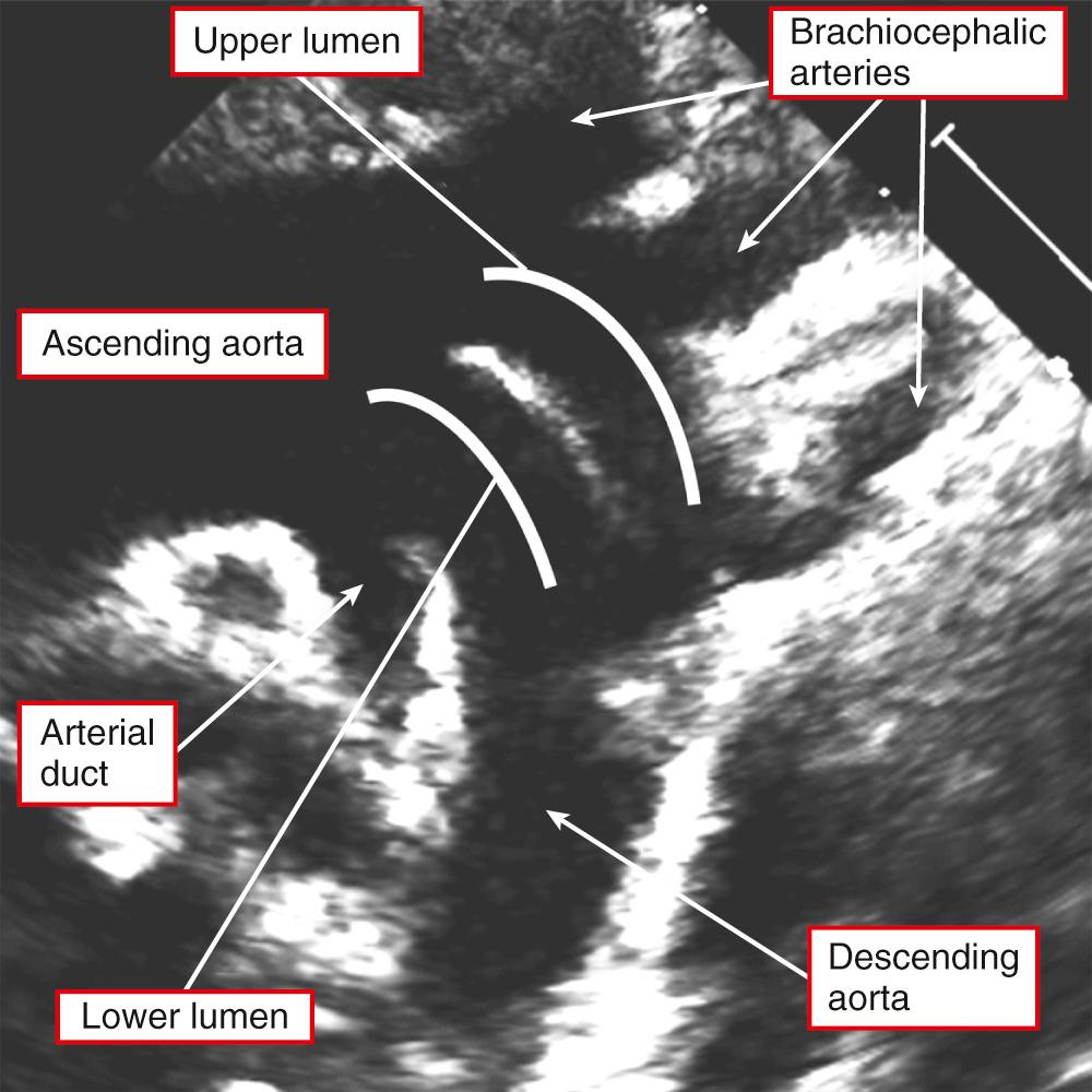 Fig. 48.7, Echocardiographic image obtained from a patient with a double-barreled aorta showing that the origin of the lower channel is opposite or distal to the take-off of the persistently patent arterial duct ( Video 48.1 ). This makes an interpretation on the basis of persistence of a collateral channel just as likely if not more so than the alternative explanation of persistence of the artery of the fifth pharyngeal arch.