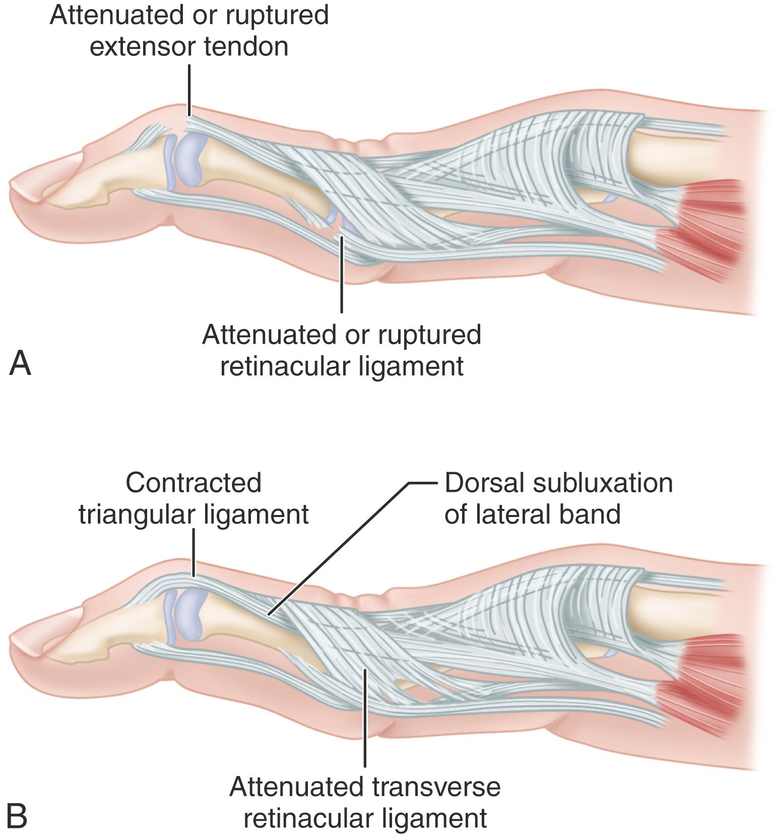 FIGURE 73.11, Swan-neck deformity. A, Terminal tendon rupture may be associated with synovitis of distal interphalangeal joint, leading to distal interphalangeal joint flexion and subsequent proximal interphalangeal joint hyperextension. Rupture of flexor digitorum superficialis tendon can be caused by infiltrative synovitis, which can lead to decreased volar support of proximal interphalangeal joint and subsequent hyperextension deformity. B, Lateral-band subluxation dorsal to axis of rotation of proximal interphalangeal joint. Contraction of triangular ligament and attenuation of transverse retinacular ligament are depicted.