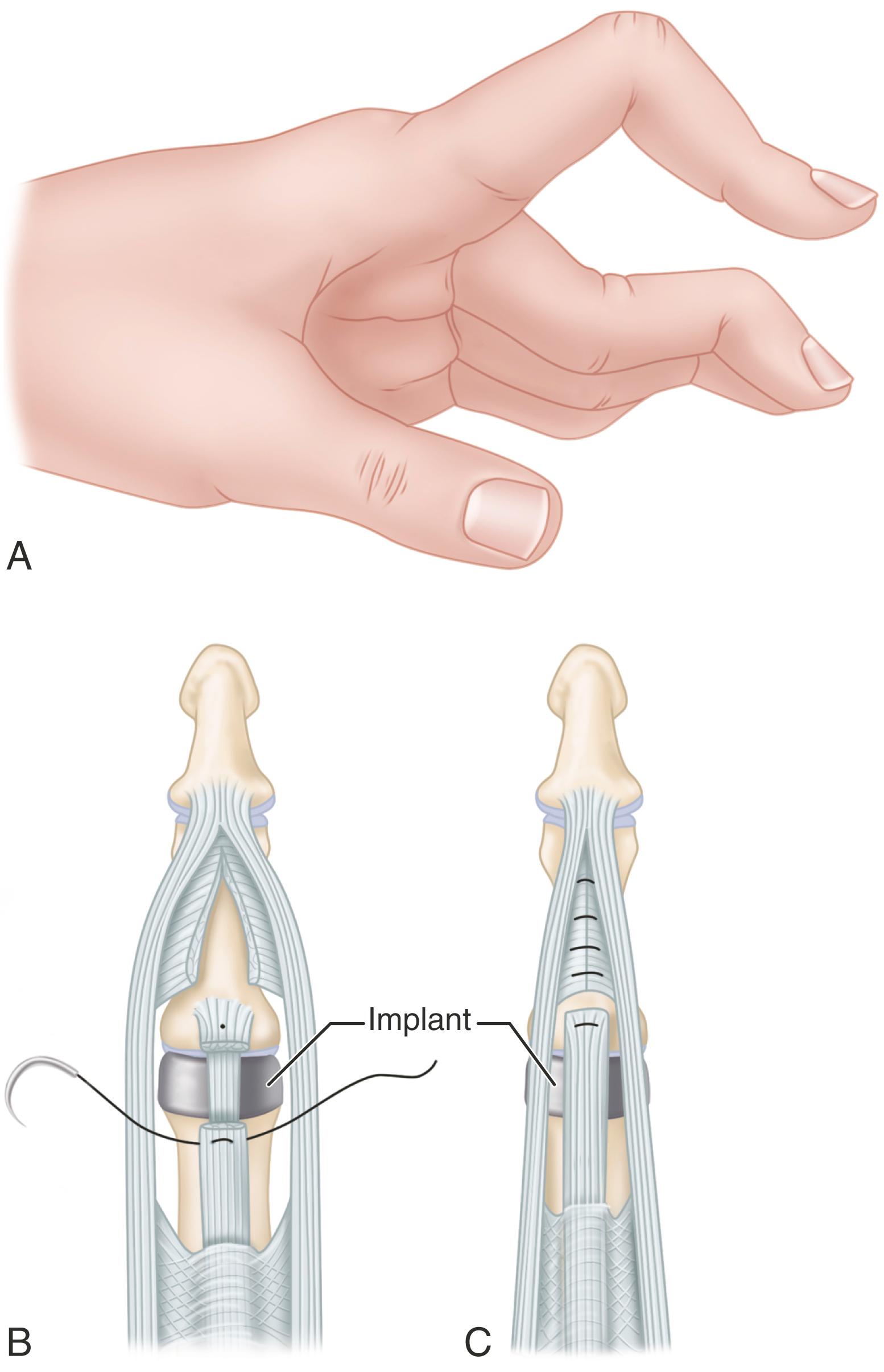FIGURE 73.18, Technique for boutonniere deformity. A, Boutonniere deformity of index finger with swan-neck deformity of other fingers. B and C, Lengthened central tendon is advanced, and lateral tendons are released and relocated dorsally by suturing their connecting fibers.