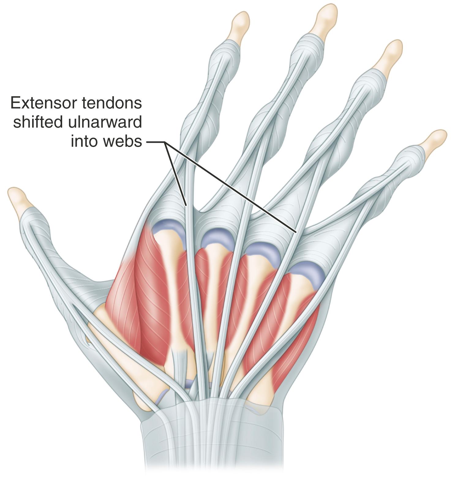FIGURE 73.20, Ulnar deviation of fingers in rheumatoid arthritis.