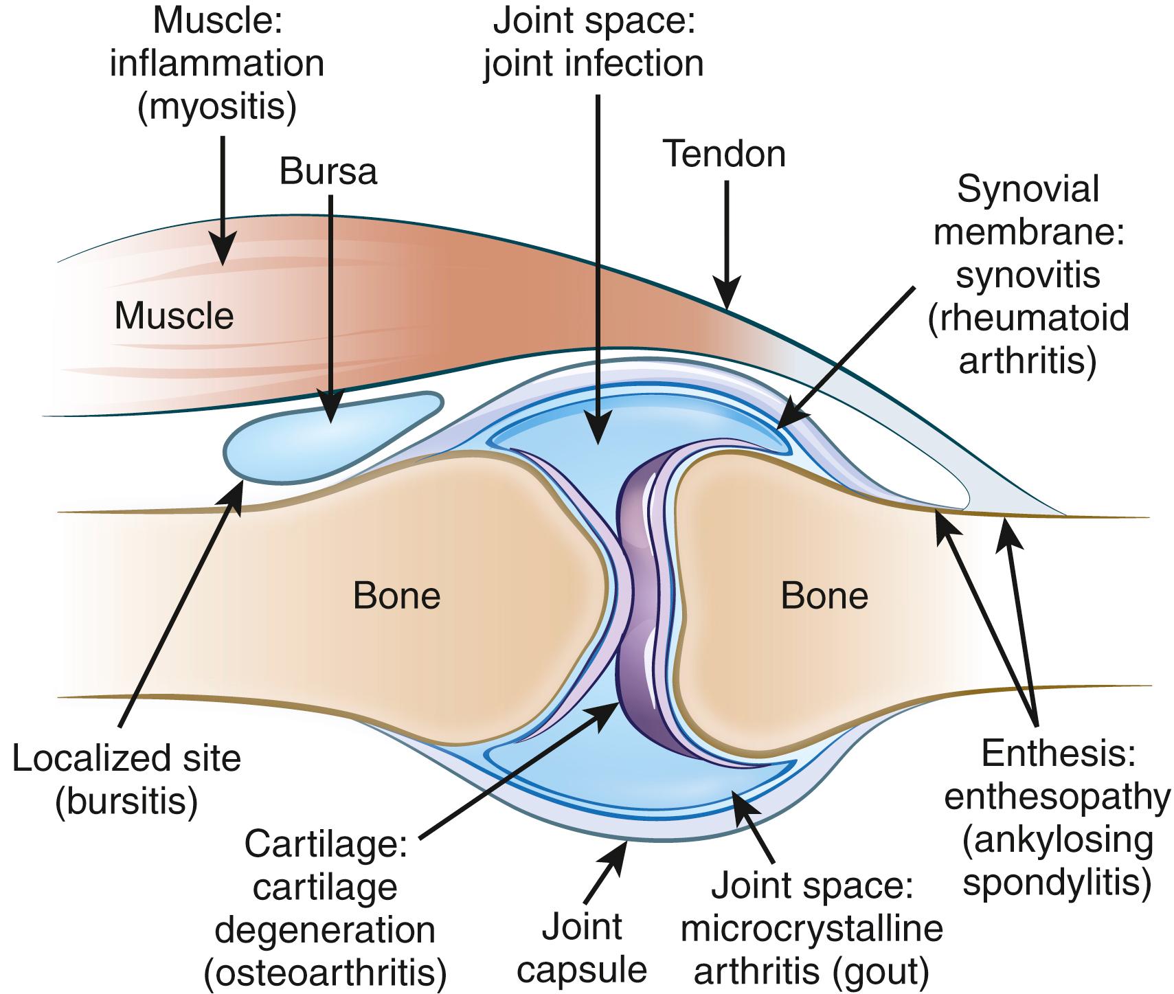 Fig. 44.2, Location of musculoskeletal disease processes by site, pathophysiologic process, and typical disease (parentheses) .