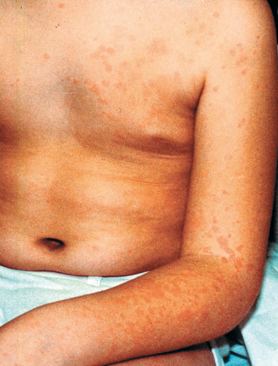 Fig. 44.4, Systemic juvenile idiopathic arthritis rash, a salmon-colored, macular rash that is nonpruritic. The individual lesions are transient, appear in crops, and may be in a linear distribution after minor trauma such as scratching the surface of the skin (Koebner phenomenon).