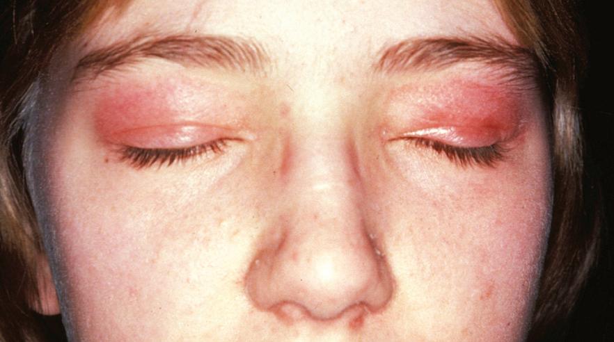 Fig. 44.5, Heliotrope rash with edema of the eyelids in juvenile dermatomyositis.