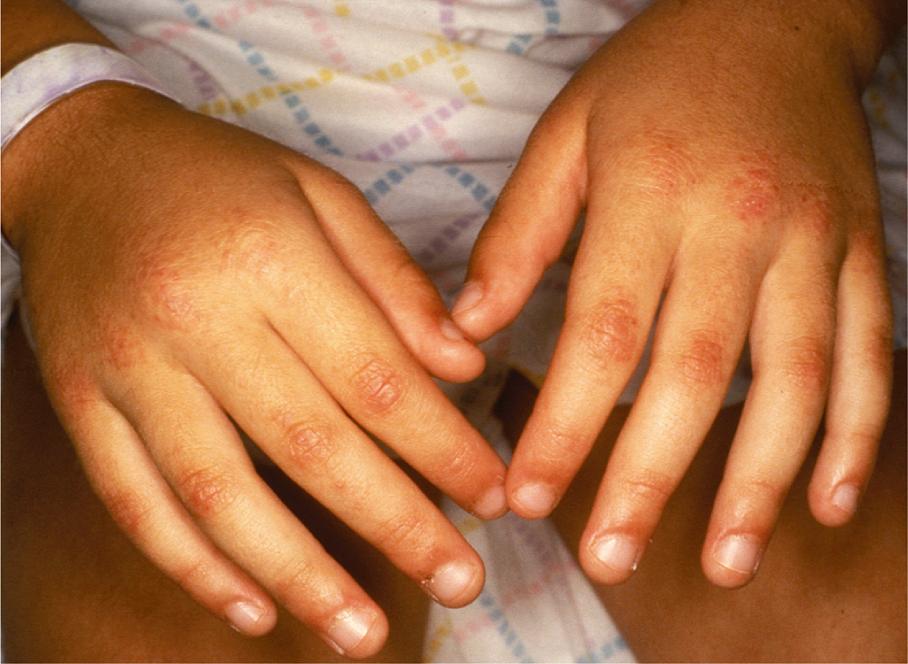 Fig. 44.6, Symmetric, scaly, erythematous plaques and papules over the metacarpopharyngeal and proximal interphalangeal joints of the hands in juvenile dermatomyositis. C, Atrophic, pale lesions may also occur.