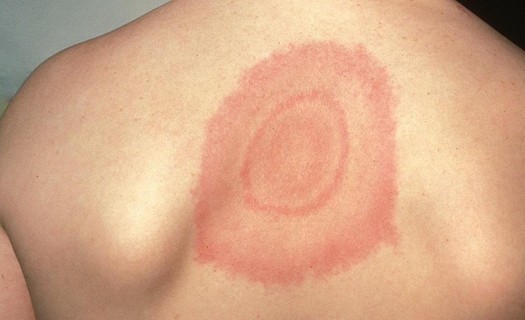 Fig. 44.7, Erythema migrans. Lesions begin as red macules that expand to form large rings that often have a typical “bull’s-eye” appearance.