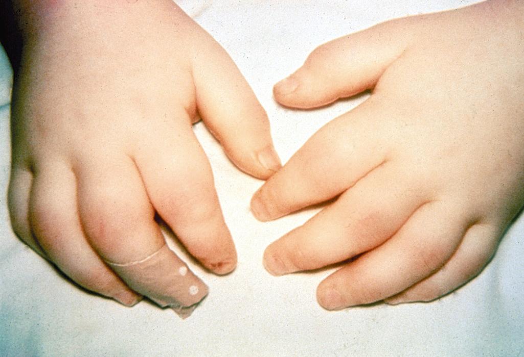 Fig. 44.8, The joints of the wrists and hands of a 2-year-old male are swollen, warm, and painful with limited extension of the fingers.