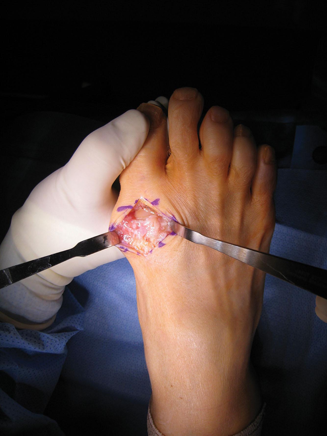 Fig. 21-1, Intraoperative degenerative joint disease of the first metatarsophalangeal joint.