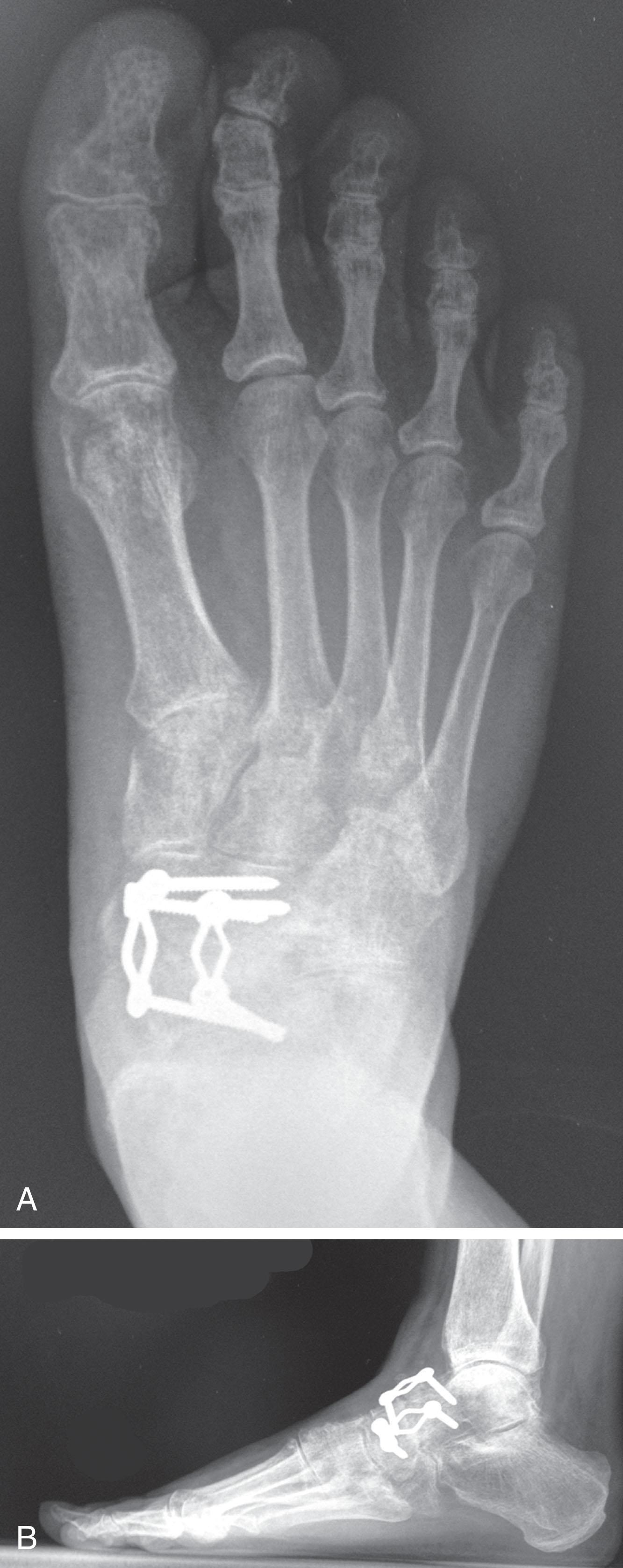 Fig. 21-11, A , Anteroposterior (AP) radiograph demonstrating talonavicular arthrodesis. B , Lateral weight-bearing radiograph showing talonavicular arthrodesis with compression plates and screws.