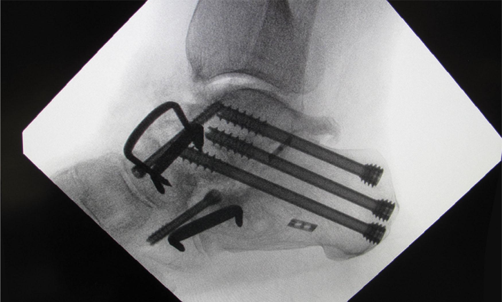 Fig. 21-12, Lateral fluoroscopic image after triple hindfoot arthrodesis.