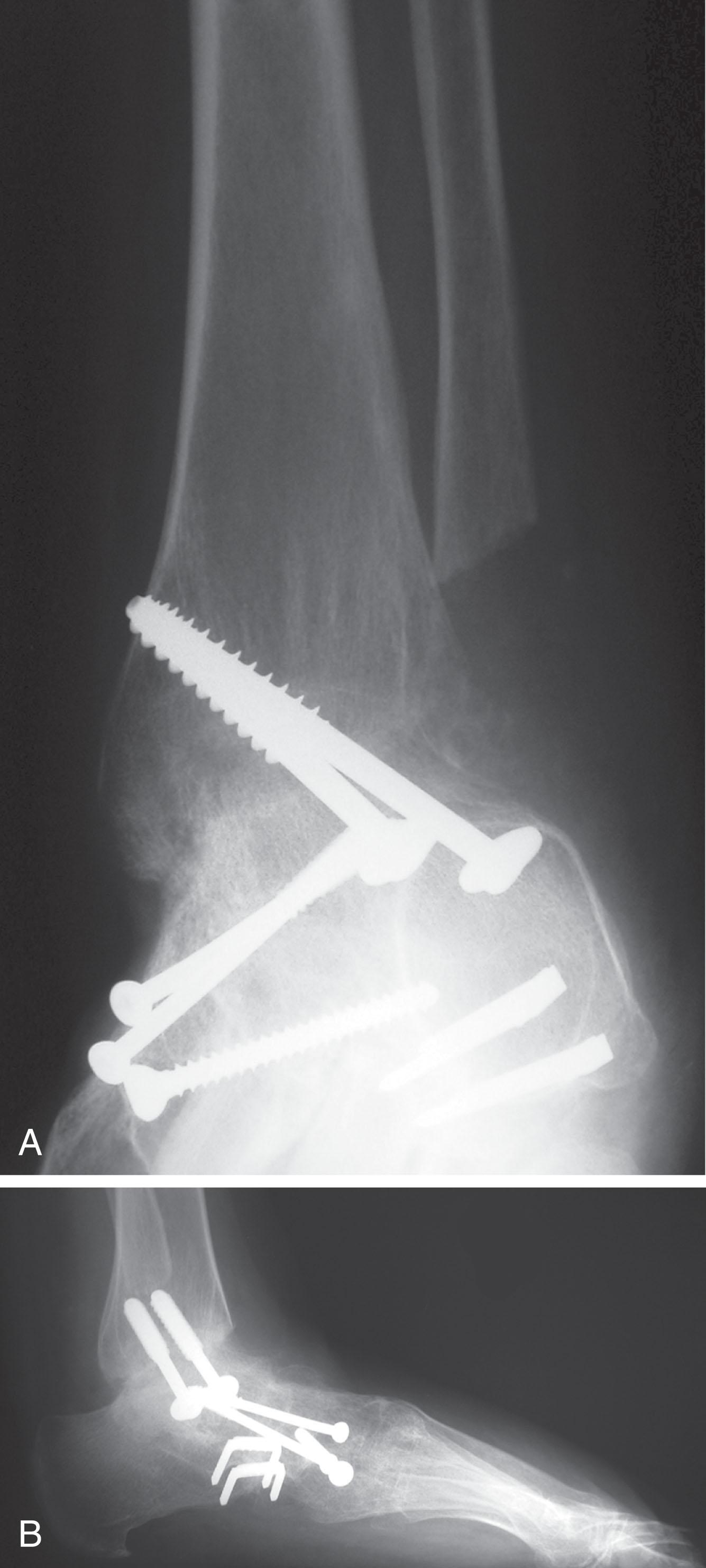 Fig. 21-13, Anteroposterior (A) and lateral (B) radiographs demonstrating a pantalar arthrodesis. This patient had a prior subtalar arthrodesis.