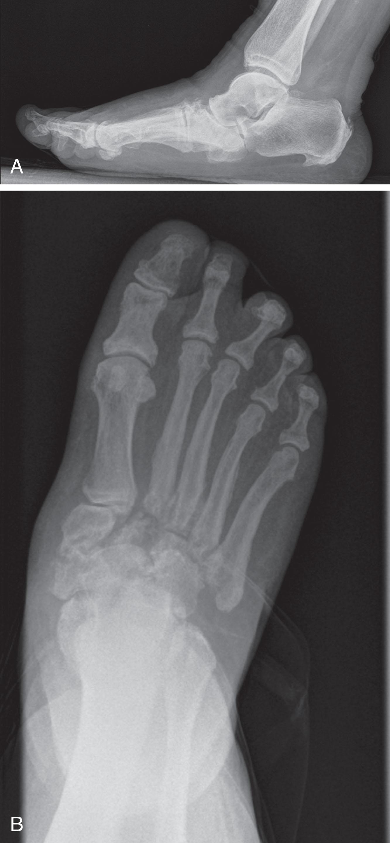 Fig. 21-14, Lateral (A) and anteroposterior (B) radiographs demonstrating a midfoot Charcot arthropathy and pes planus deformity.