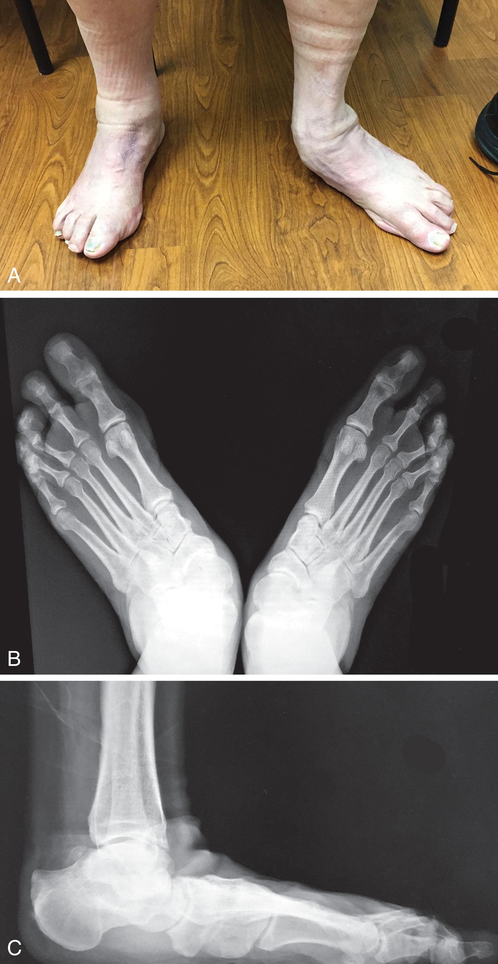 Fig. 21-15, Clinical photograph of midfoot abduction deformity (A) and anteroposterior (B) radiographs. C , Lateral weight-bearing radiograph of pes planus deformity with talonavicular joint subluxation.