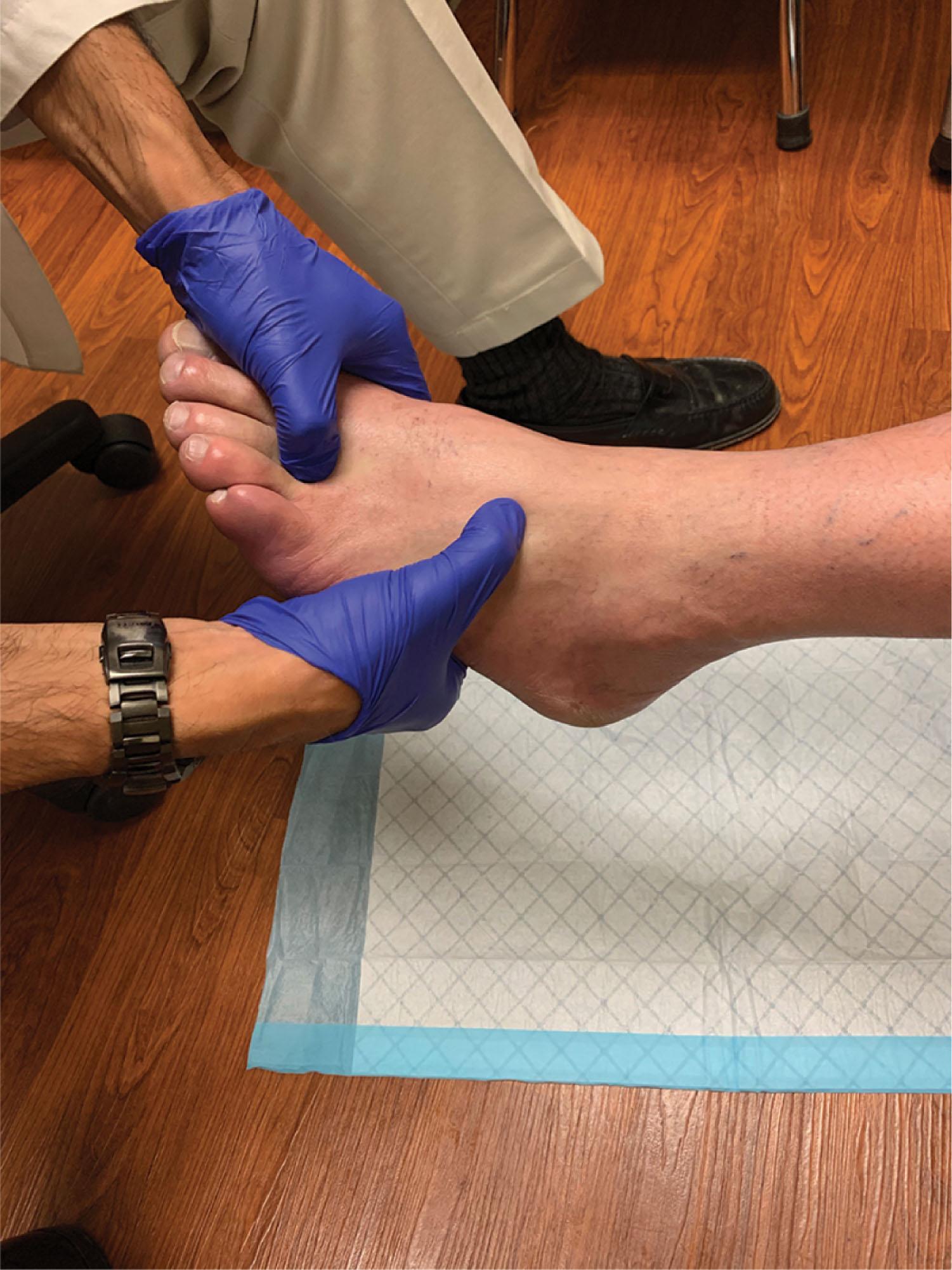 Fig. 21-16, The piano-key test is positive when a patient feels pain in their tarsometatarsal joint with a plantarly directed force applied to the metatarsal head.