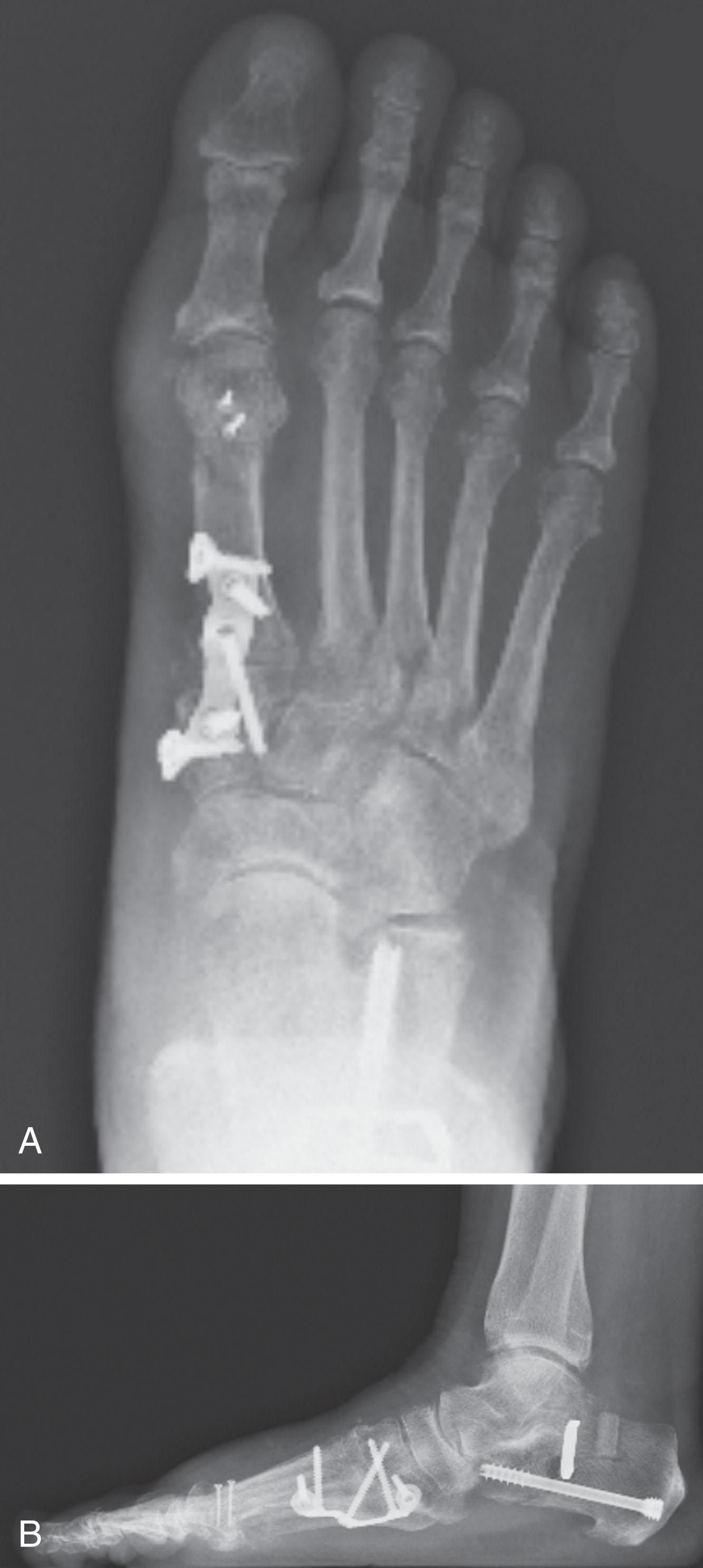 Fig. 21-18, Anteroposterior (A) and lateral (B) radiographs of a first tarsometatarsal joint arthrodesis with a plantar plate and lag screw.