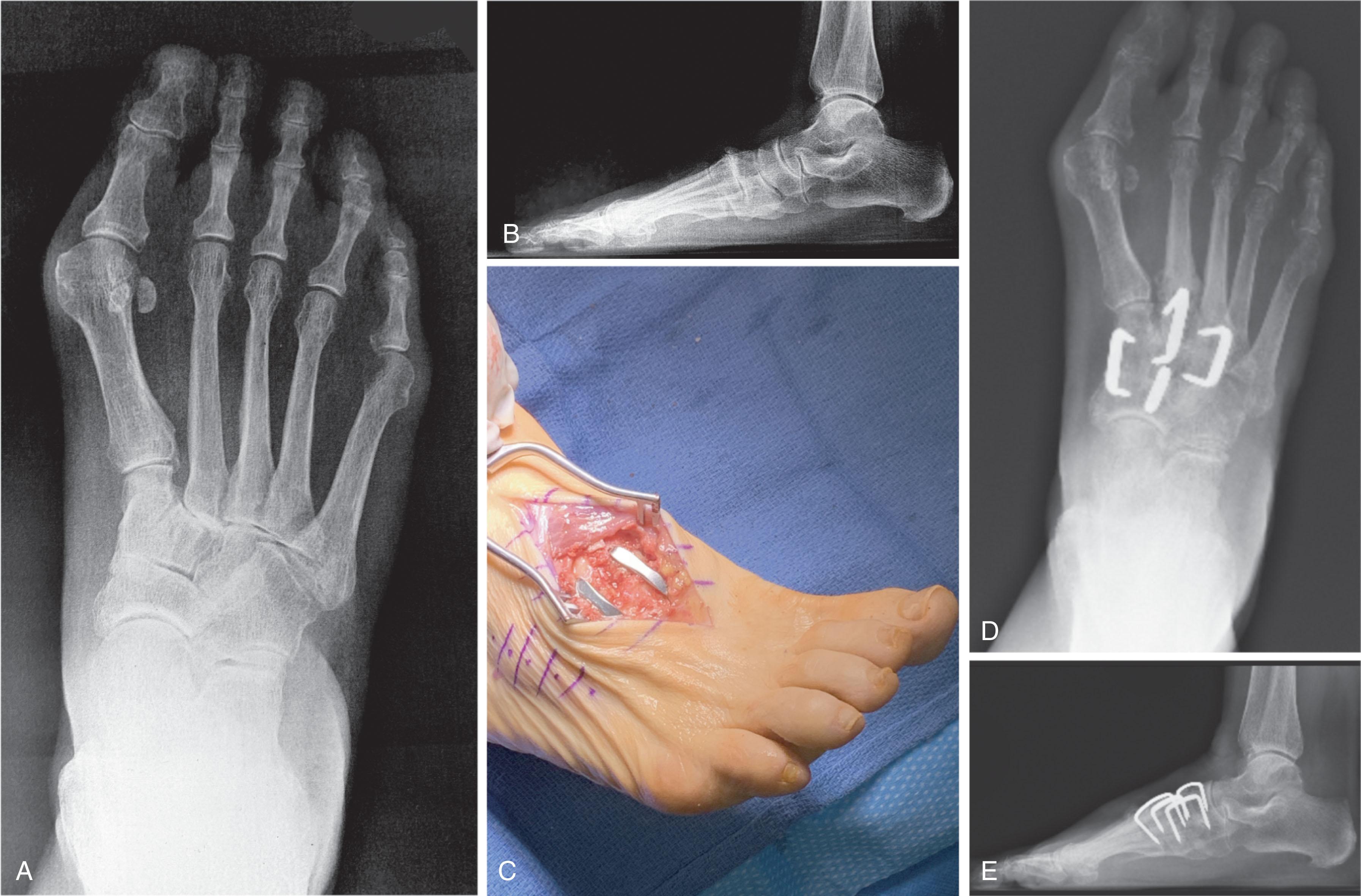 Fig. 21-19, A , Preoperative anteroposterior and B , lateral radiograph of symptomatic navicular cuneiform and second and third tarsometatarsal arthritis. C , Intraoperative photograph of second and third tarsometatarsal arthrodesis. D , Postoperative anteroposterior and (E) lateral radiograph of navicular cuneiform and second and third tarsometatarsal arthrodesis with Nitinol compression staples.