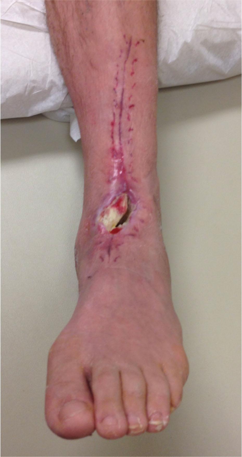 Fig. 21-20, Delayed wound healing incision in a patient with diabetes.