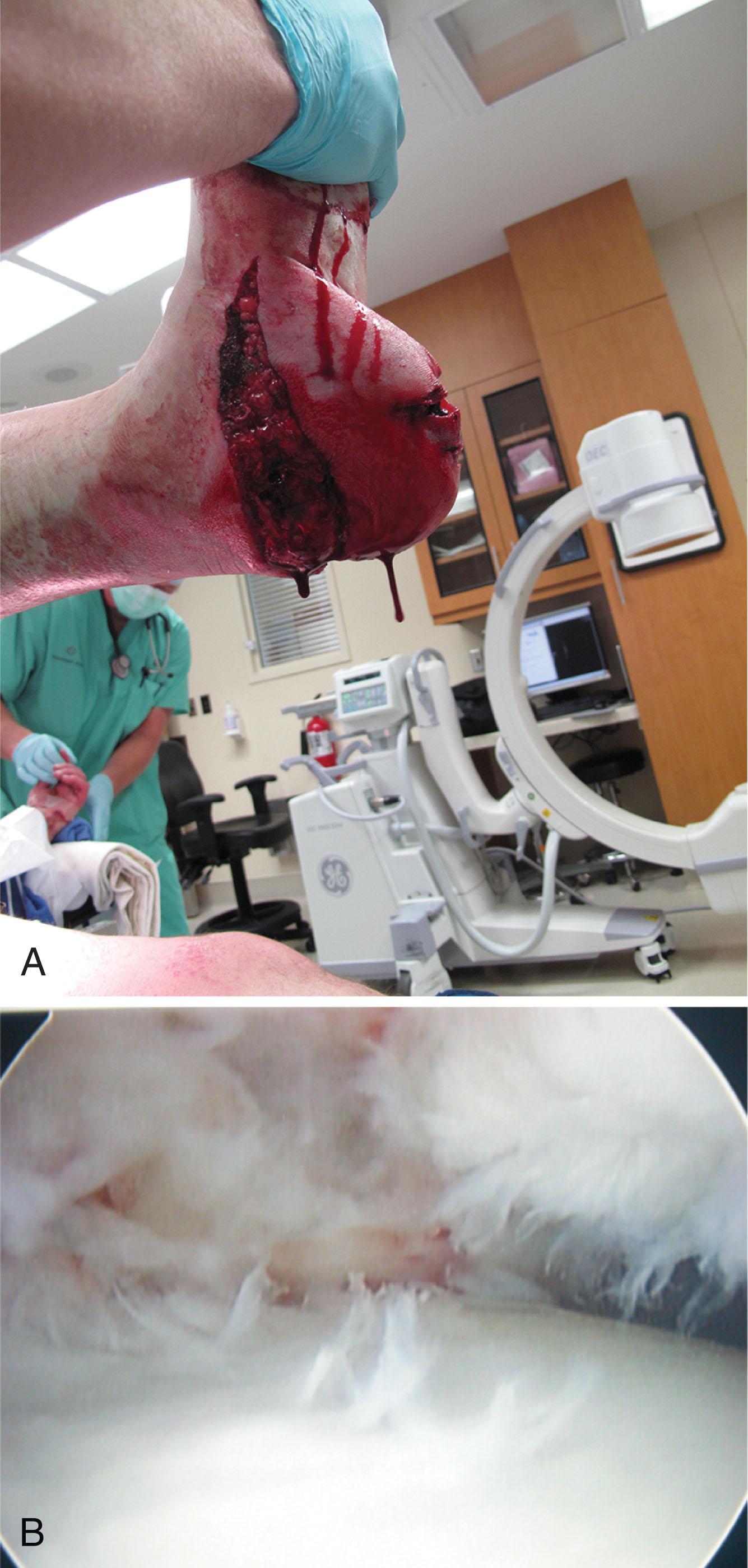 Fig. 21-2, A , Intraoperative photograph of an open calcaneal fracture. B , Arthroscopic intraarticular photograph of soft fissuring and friable cartilage.