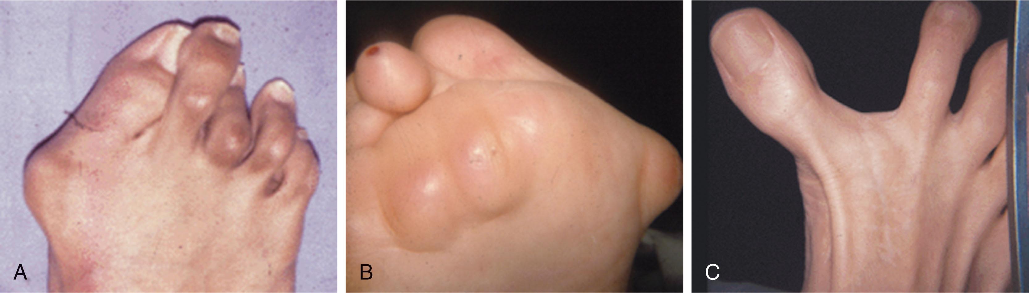 Fig. 21-21, A , Clinical photograph of hallux valgus deformity with subluxation of the lesser metatarsophalangeal joints and complex hammer toe deformities. B , Plantar clinic photograph demonstrating lesser toe dislocation and plantar keratoses. C , Hallux varus deformity clinical photograph with lateral soft tissue attenuation and rupture.