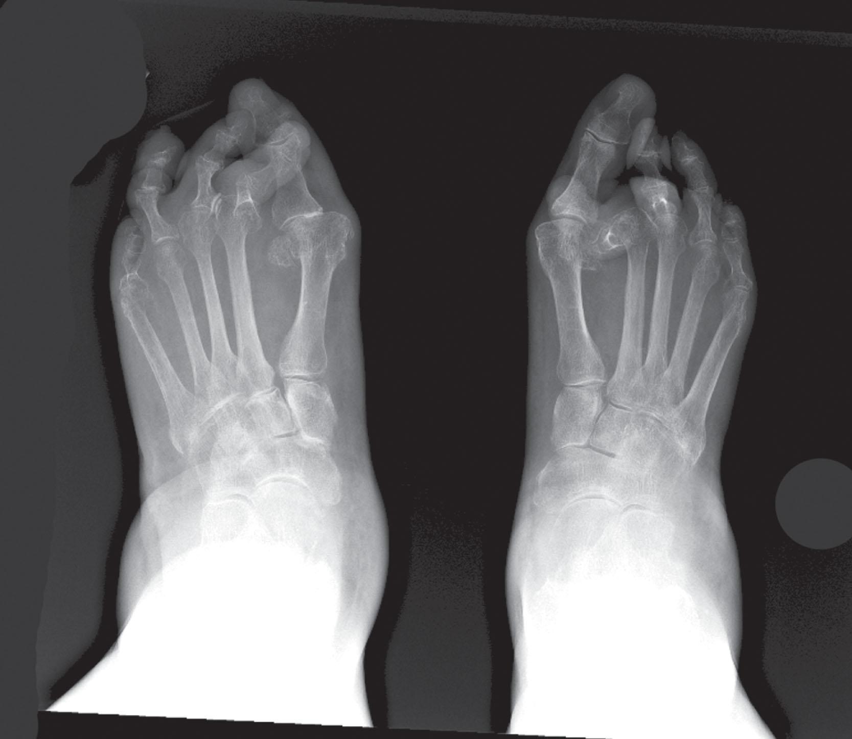 Fig. 21-22, Radiograph of a patient with rheumatoid arthritis. Second metatarsophalangeal joints are dislocated bilaterally with severe crossover deformities.