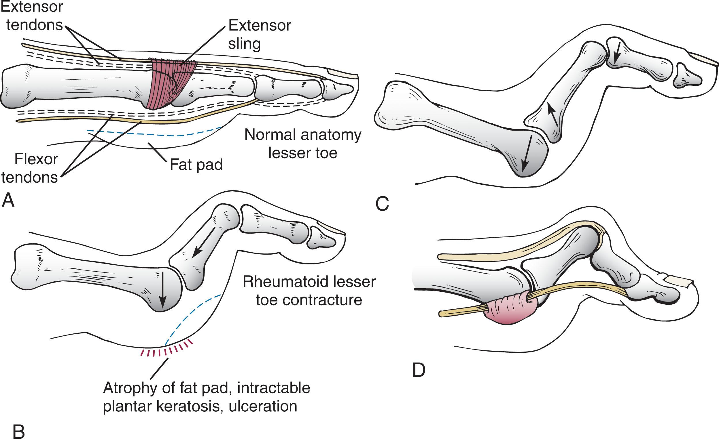 Fig. 21-23, A , Normal alignment and balance of the metatarsophalangeal (MTP) joints and toes. Fat pad is centered beneath metatarsal heads. B , As rheumatoid deformity progresses, an imbalance occurs with progressive dorsal subluxation of the MTP joints and deformities of the lesser toes. The fat pad is drawn distally by the contracting lesser toes. C , End-stage deformity. Dislocation of the MTP joint with proximal phalanx ankylosed to the dorsal aspect of the metatarsal head. This forces the metatarsal head into the plantar aspect of the foot and results in severe callus formation. Lesser toes develop hammer toe deformities that often become severely contracted, and the fat pad is drawn distally and is no longer in a functional position. D , With chronic dorsiflexion deformity of the proximal phalanx at the MTP joint, flexor tendons subluxate dorsally, becoming functional extensors of the MTP joint.