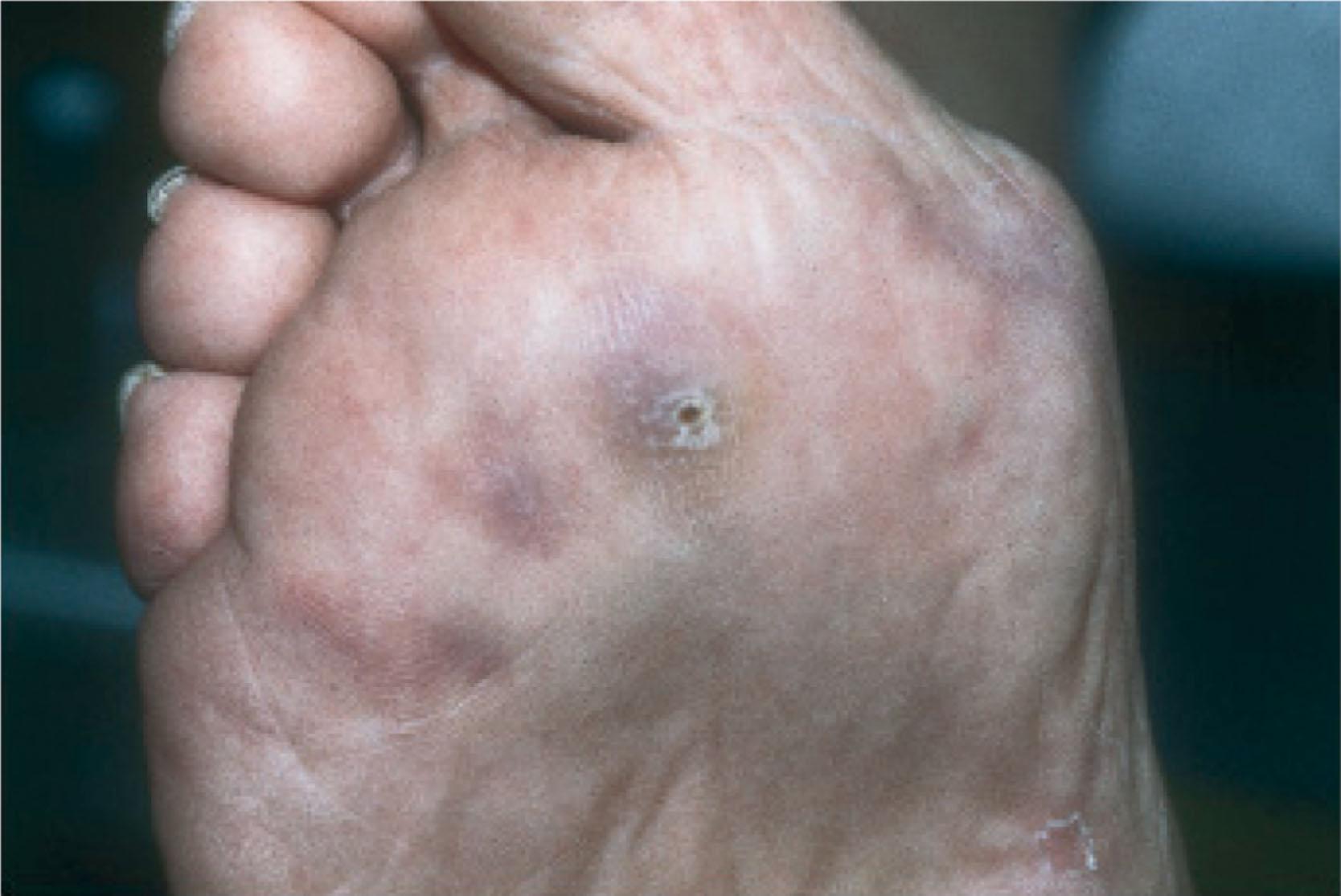 Fig. 21-24, Plantar forefoot ulceration after chronic lesser metatarsophalangeal dislocation.