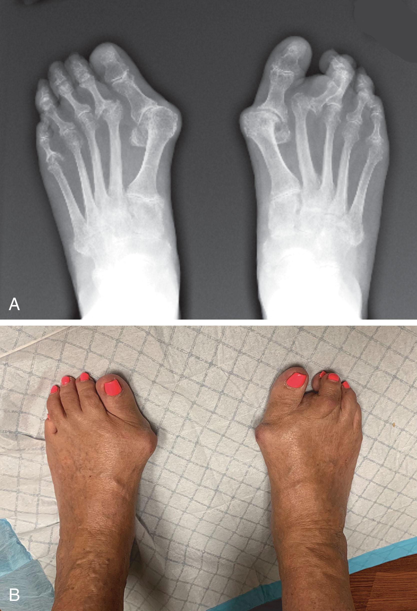 Fig. 21-25, A , Preoperative radiograph demonstrates right second metatarsophalangeal (MTP) joint dislocation, left fifth metatarsal head marginal erosion, hallux valgus deformities. B , Clinical photograph demonstrates hallux valgus deformities and right second metatarsophalangeal joint dislocation.