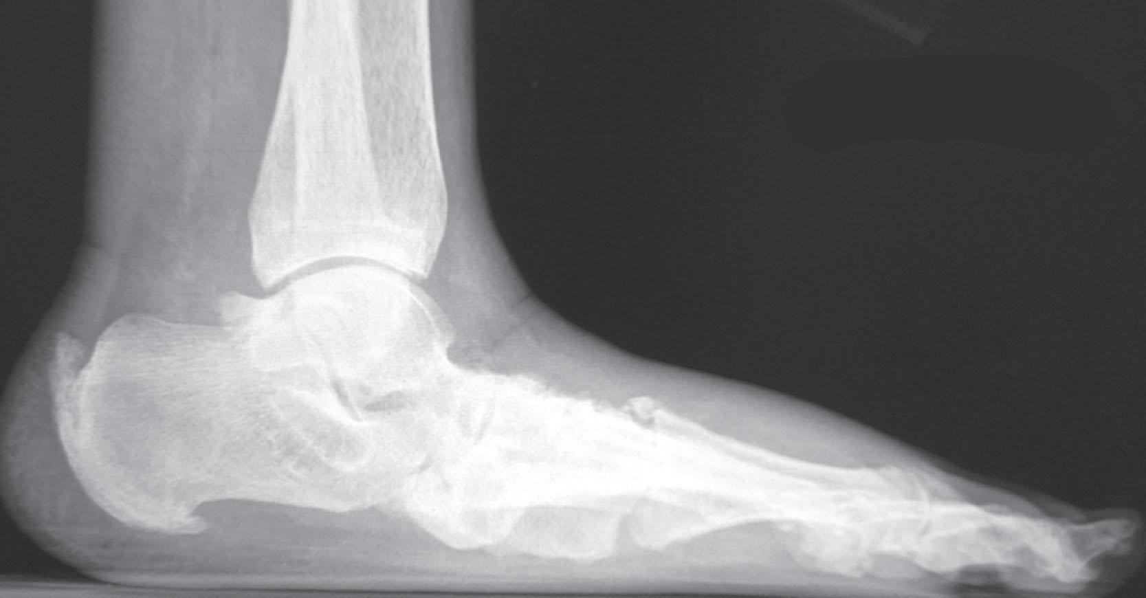 Fig. 21-26, Midfoot arch collapse with migration of the talar head plantarward.