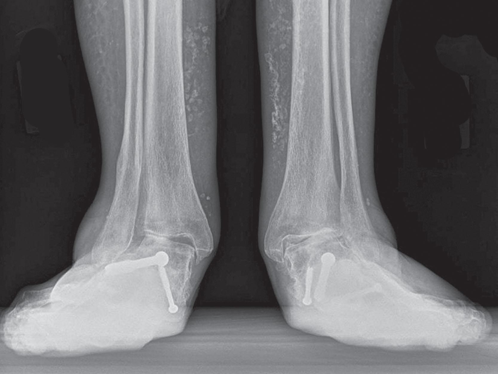 Fig. 21-28, Radiographs depicting bilateral incongruent ankle valgus deformities.