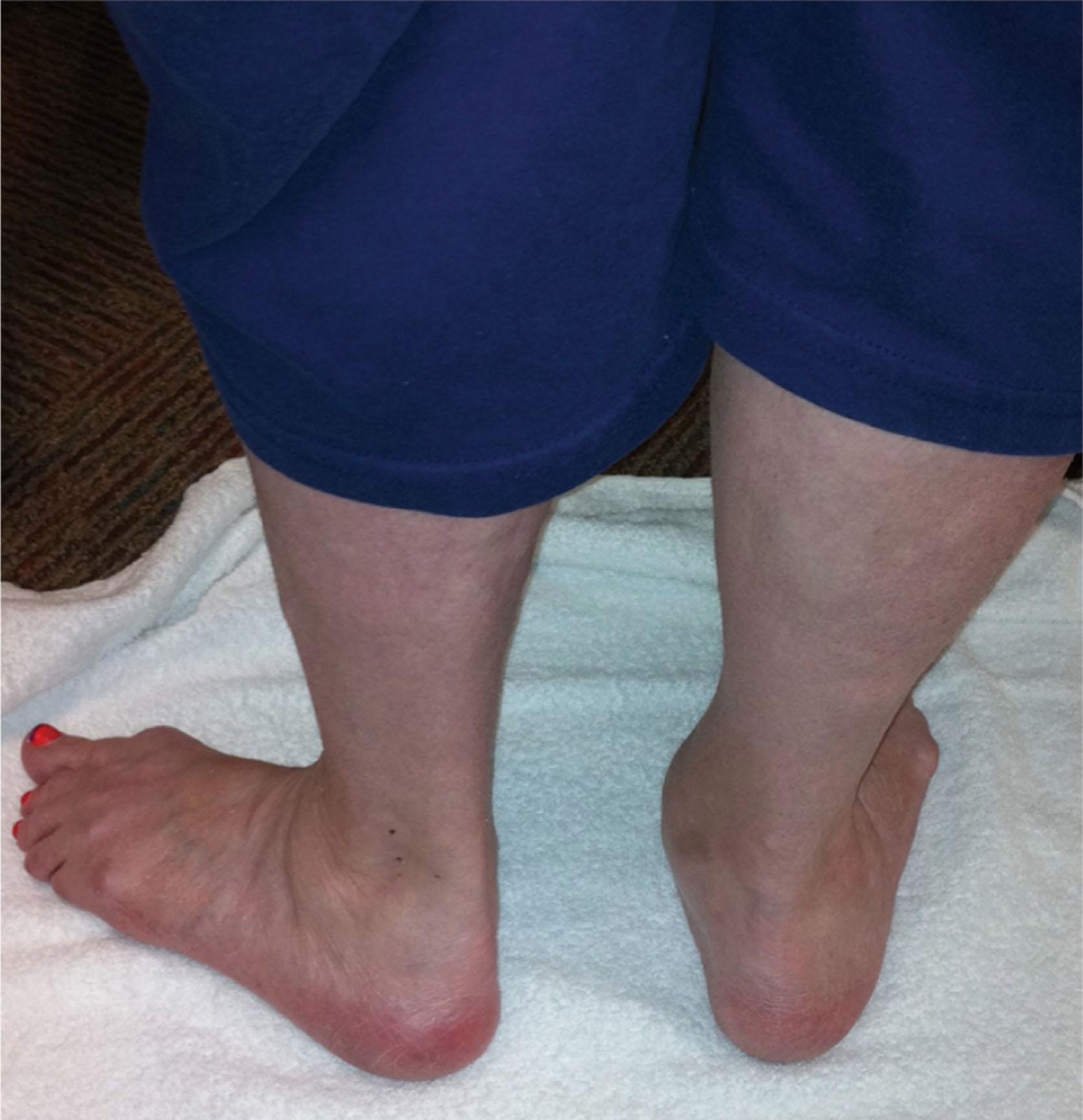 Fig. 21-29, Hindfoot valgus in a patient with rheumatoid arthritis.
