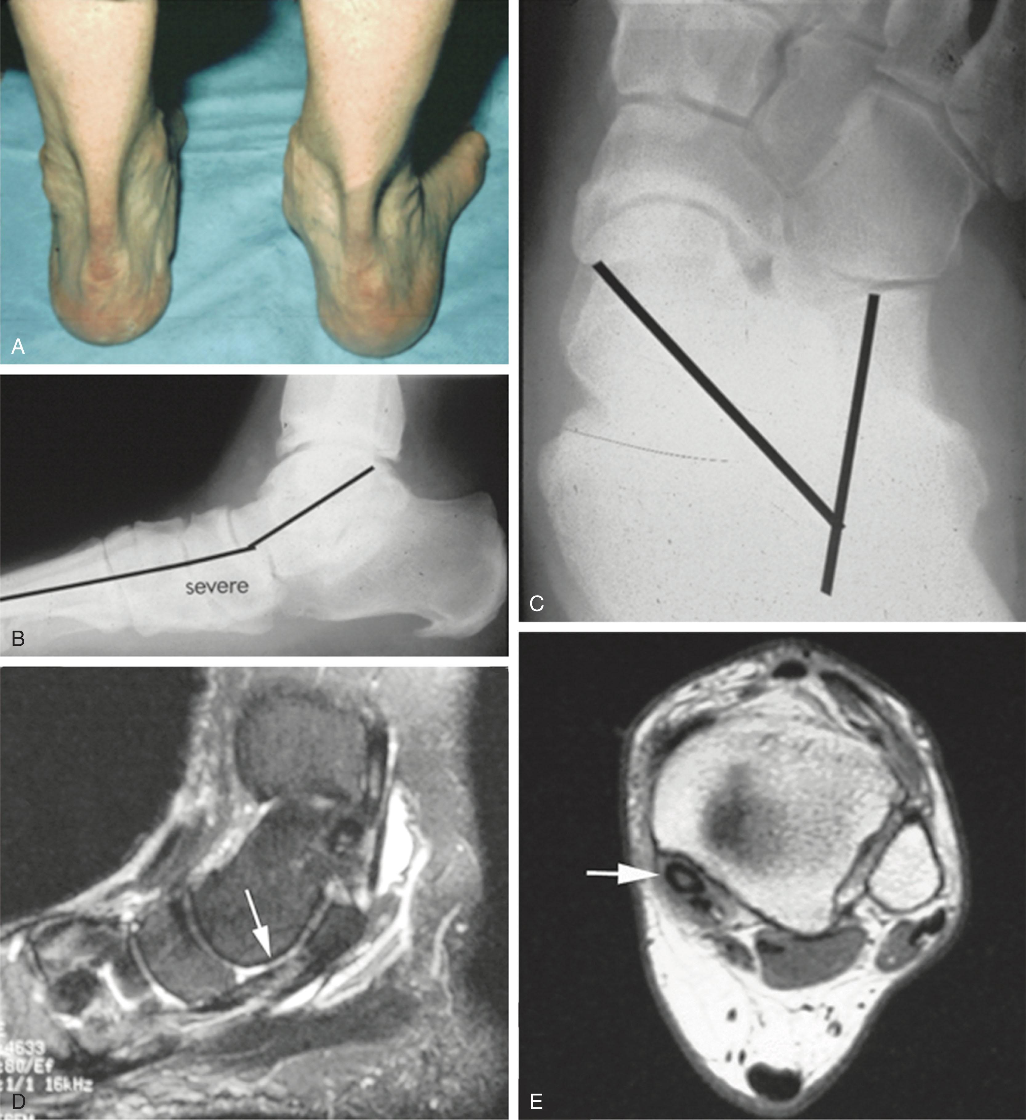 Fig. 21-30, Severe hindfoot deformity secondary to rheumatoid arthritis. A , Clinical photograph showing hindfoot valgus position. B , Because of inadequate support to the talus, the talus has assumed an extremely plantar-flexed position with resultant pes planus as shown on the lateral radiograph. C , Peritalar subluxation is notable on the anteroposterior radiograph. D and E , Magnetic resonance images show posterior tibial tendon tendinosis and high-grade signal change within the tendon ( arrow denotes diseased posterior tibial tendon).