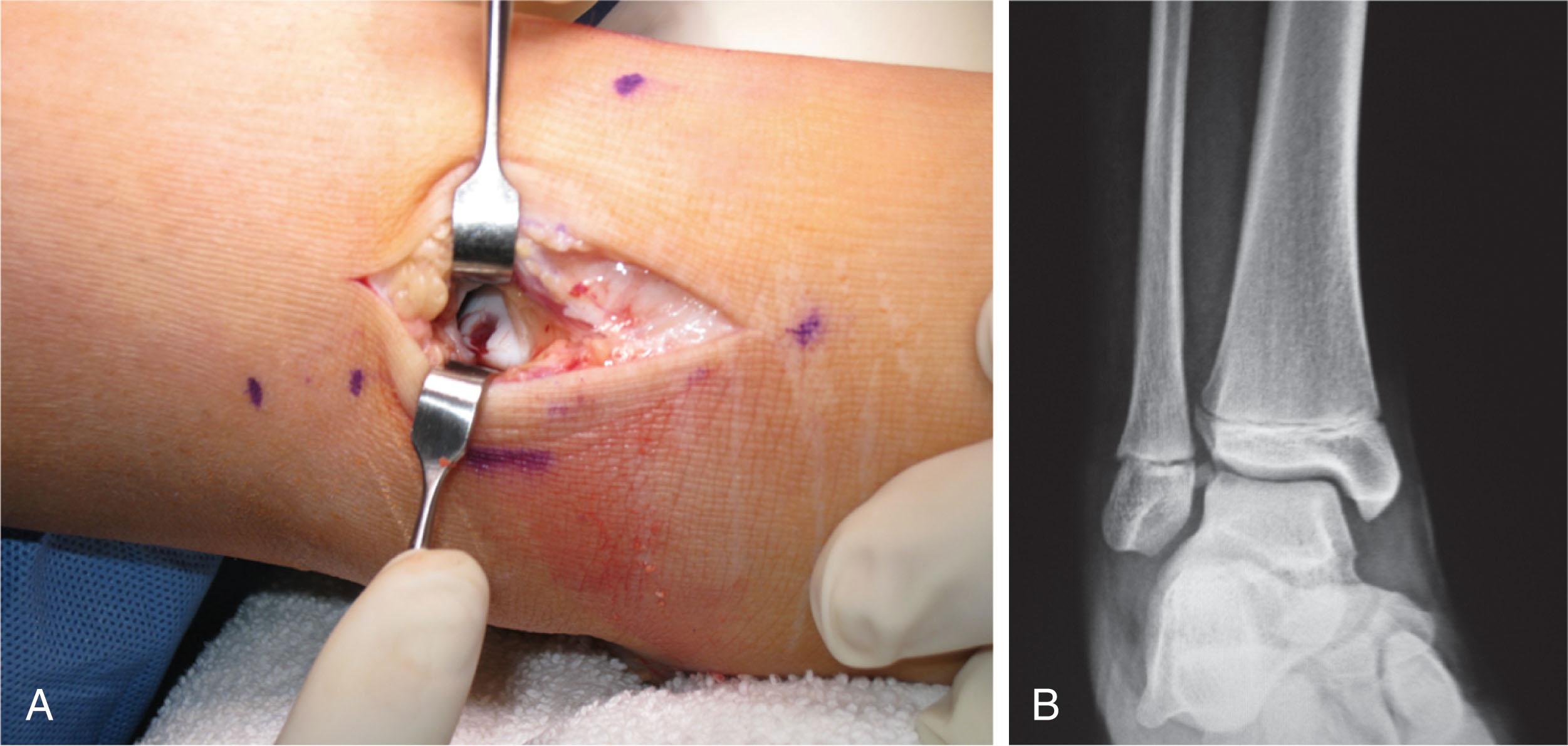 Fig. 21-3, A , Lateral talar osteochondral defect secondary to trauma. B , Anteroposterior radiograph of the free-floating fragment of the talar osteochondral defect.