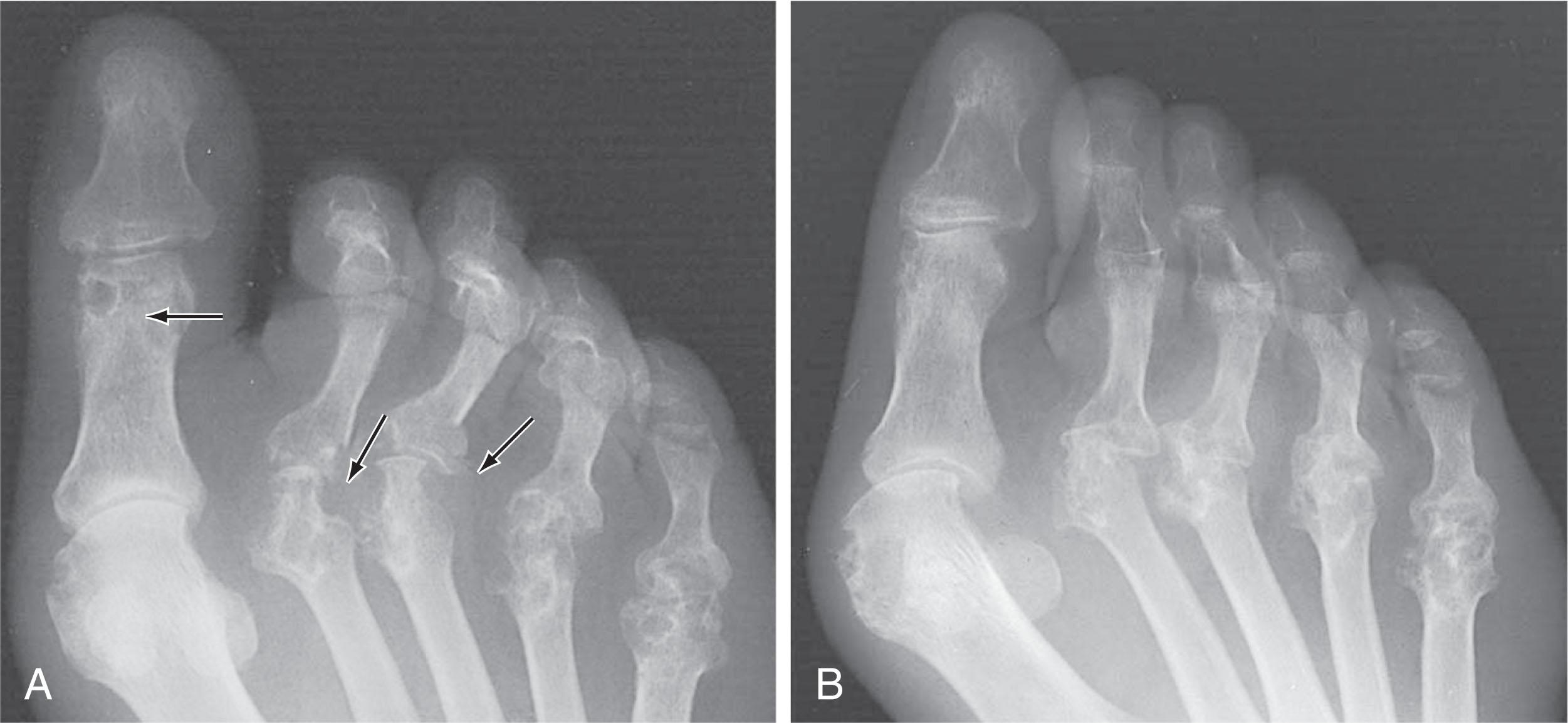 Fig. 21-31, A , Forefoot radiograph demonstrates periarticular erosions of the lesser metatarsal heads. B , Subluxation, dislocation, joint space narrowing, and central erosions of the lesser metatarsophalangeal joints with hallux valgus deformity.