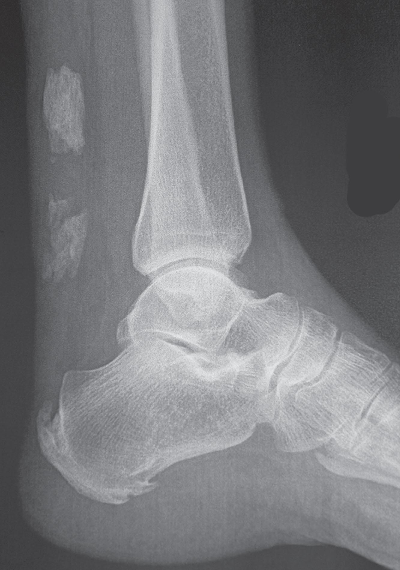 Fig. 21-32, Calcification of the Achilles tendon and the Achilles insertion.