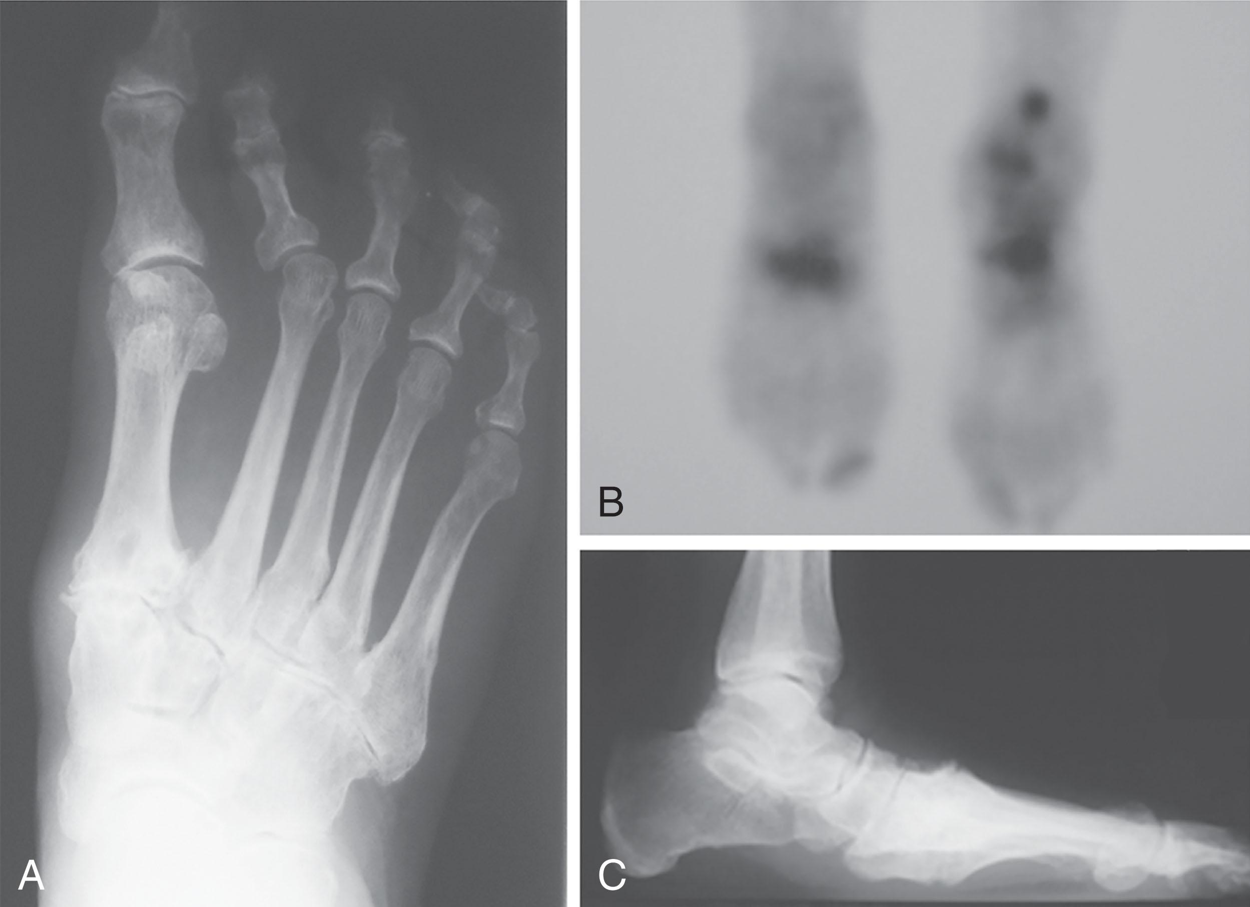 Fig. 21-33, A , Anteroposterior (AP) radiograph demonstrates severe arthritis of the Lisfranc joint. B , Technetium-99 bone scan shows bilateral midfoot uptake as well as uptake in the left ankle and hindfoot. C , Lateral radiograph demonstrates midfoot arthritis with pes planus and rocker-sole deformity.